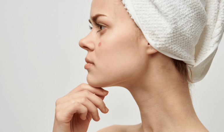 Medical Aesthetician’s Guide To Curing Acne – Aesthetic Arts Institute
